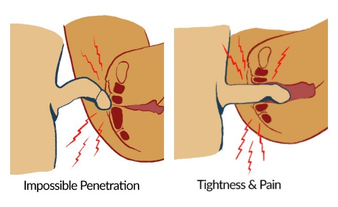 Vaginismus image